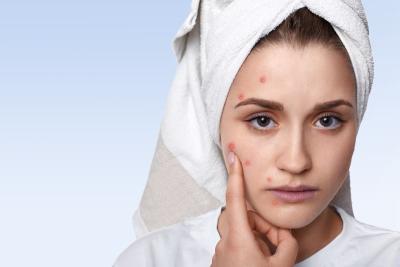 Ketahui Apa Itu Jerawat dan Bagaimana Cara Mengobatinya!