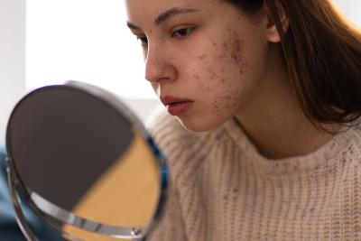 Kenali Pemicu Jerawat di Pipi dan Cara Mengobatinya