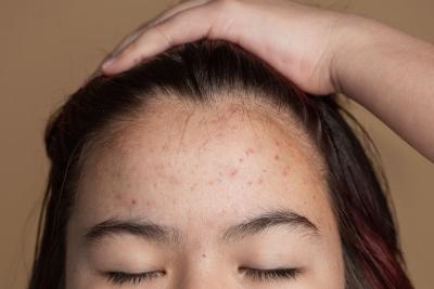 Pahami Arti Kemunculan Jerawat di Jidat & Pengobatannya