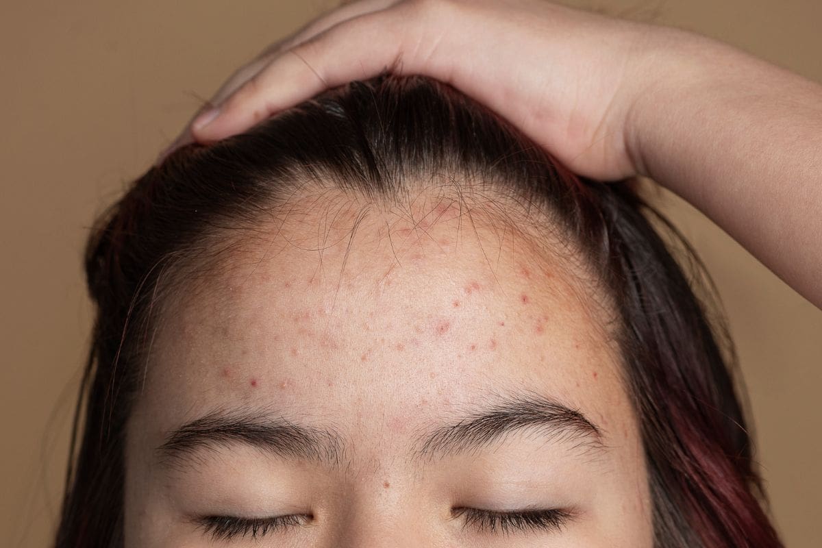 Pahami Arti Kemunculan Jerawat di Jidat & Pengobatannya