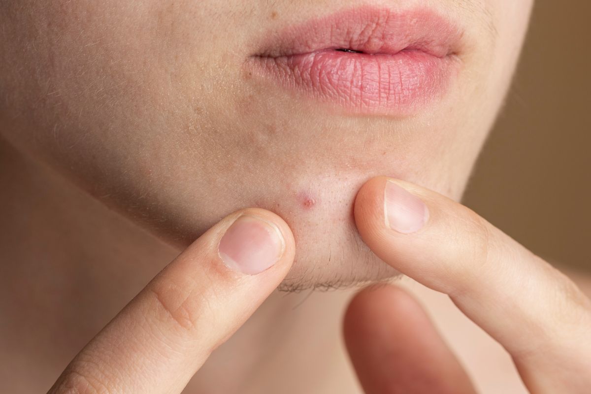 orang yang akan memencet jerawat di dagu