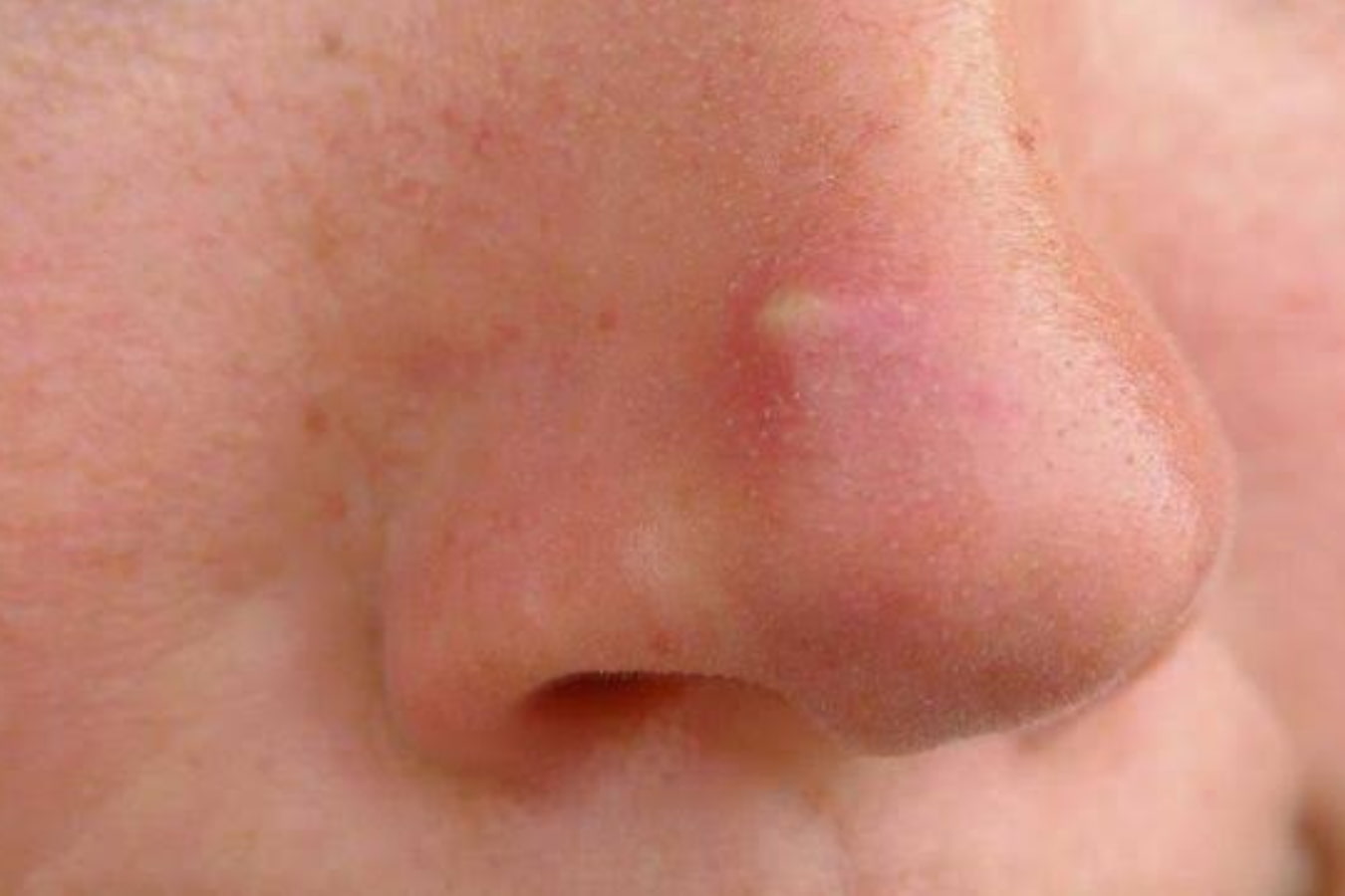 orang dengan jerawat di hidung