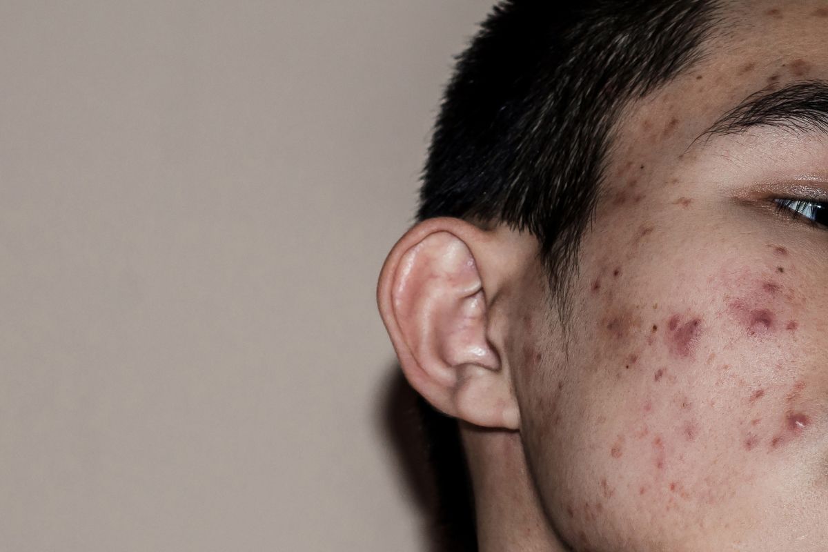 Wajah dengan kondisi bekas jerawat yang menghitam di pipi