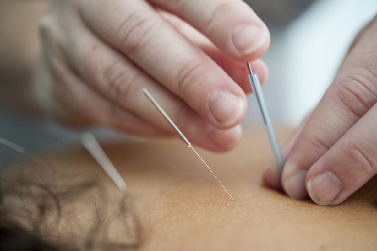 Menusukkan jarum akupuntur ke punggung pasien